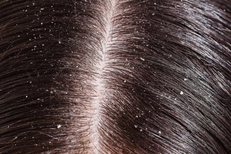 Dandruff, Frizzy hair and Itchy Scalp, Mend Zone