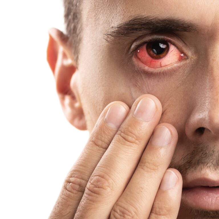 Pink Eye (Conjunctivitis) Symptoms, Causes, Treatment, and FAQs by m,end.zone