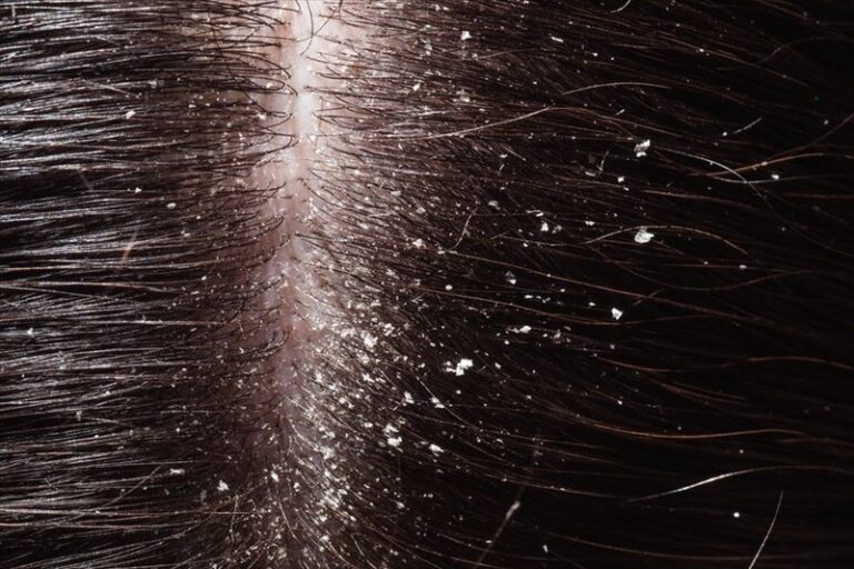 Banish Dandruff Naturally Effective Home Remedies & Prevention Tips by mend.zone