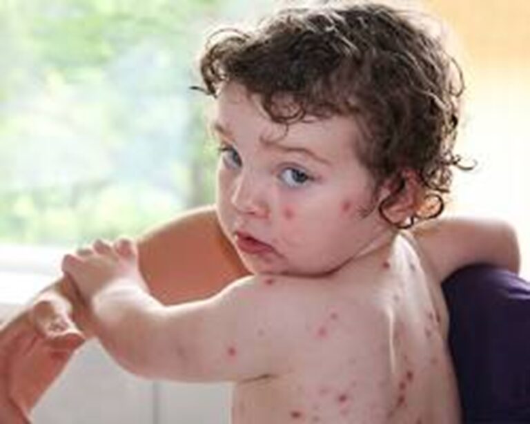 Chickenpox (Varicella) : Causes, Symptoms, Prevention, and Treatment