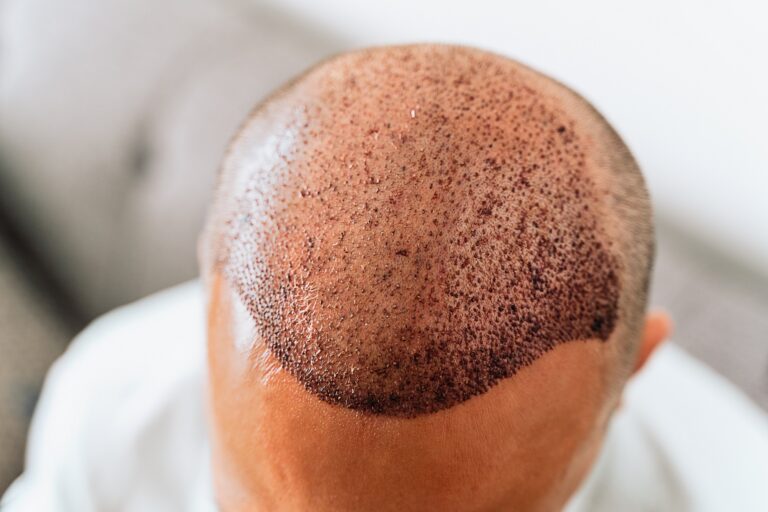 Hair Transplant Side Effects Navigating the Road to a Fuller Head of Hair