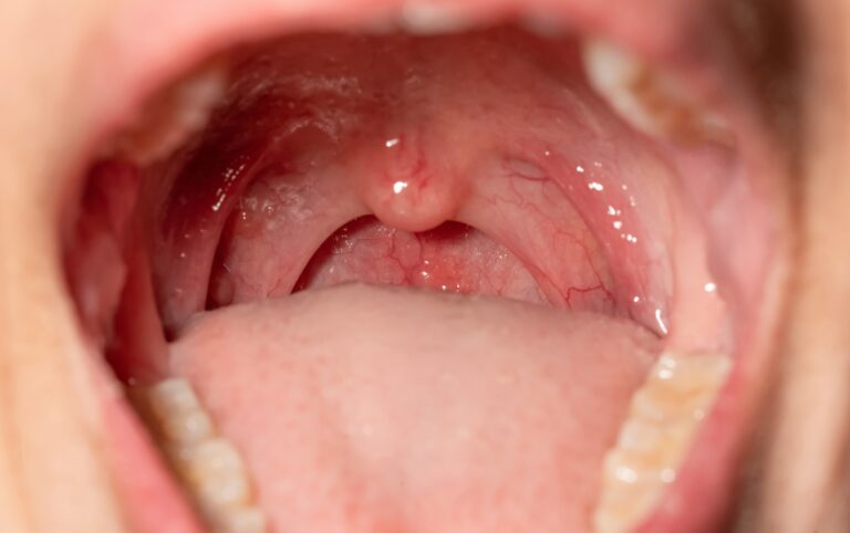 Home Remedies for Tonsil Stones: Precautions and FAQs