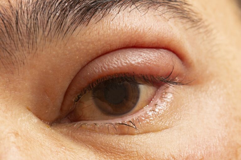 Eye Care Tips: Navigating the Discomfort of a Stye