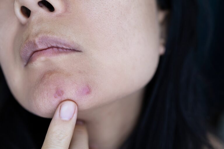 Why You Keep Getting Pimples in the Same Spot and How to Break the Cycle mend.zone