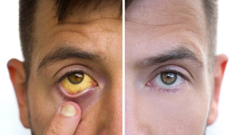 Jaundice Symptoms, Types, Causes, and Treatment, mend.zone