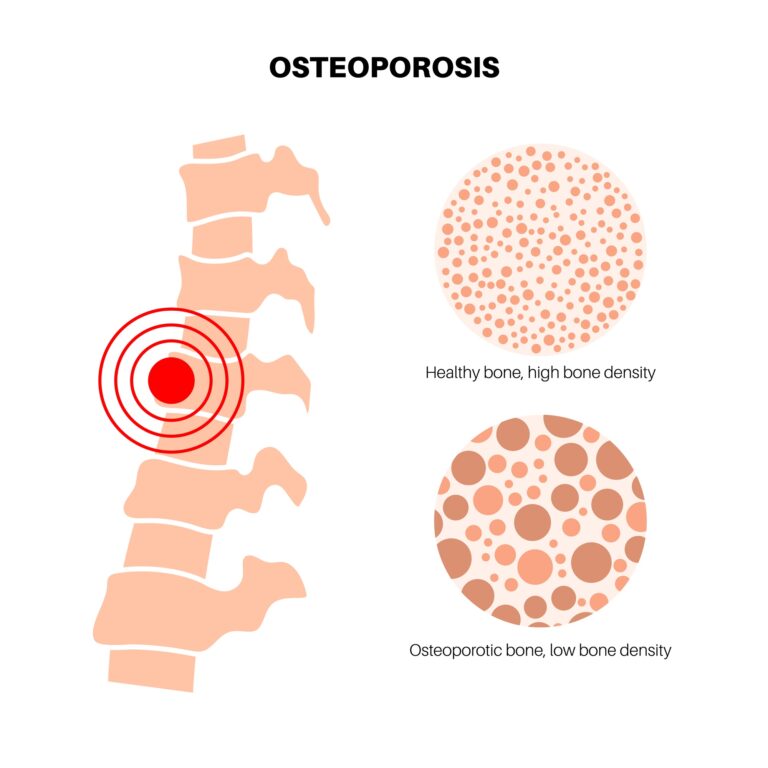 Osteoporosis Understanding, Preventing, and Managing Bone Health