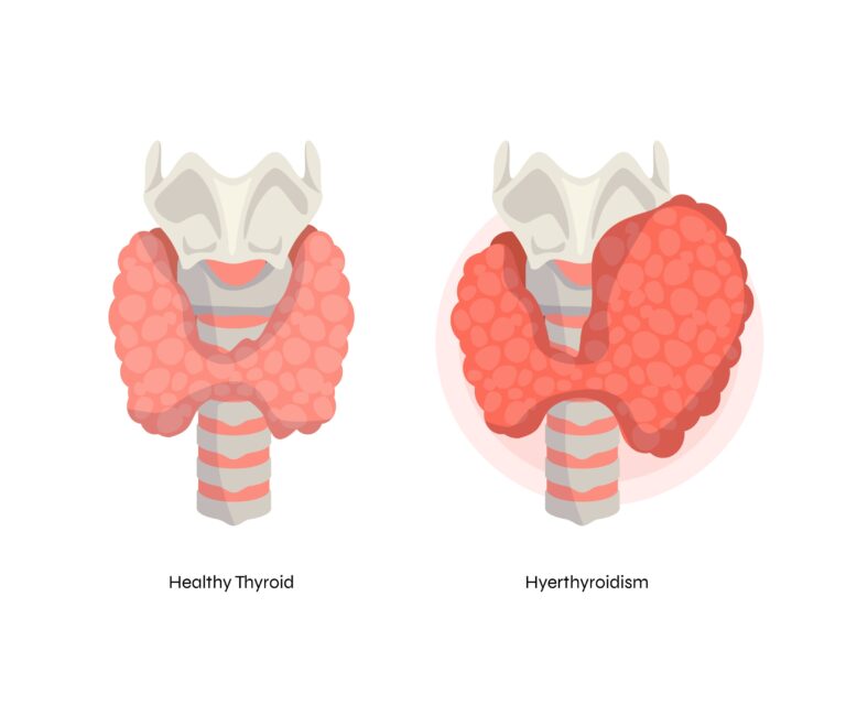 Thyroid Symptoms, Causes, Prevention, and Treatment